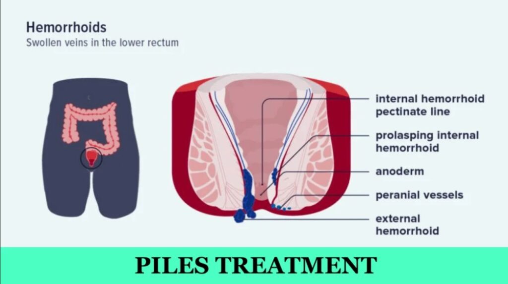 piles treatment in madurai