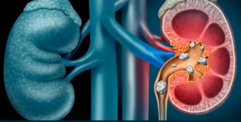 kidney stone treatment in madurai